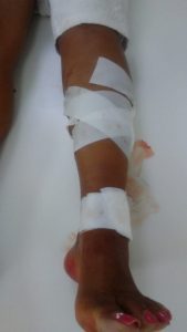 Pierna accidente
