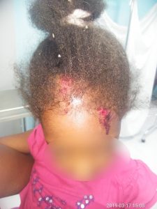 Niña acciedente