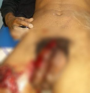 Pene herido