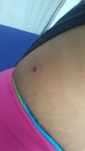 Herida abdomen
