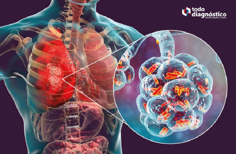 Neumonía Factores De Riesgo Y Prevención Las Calientes Del Sur